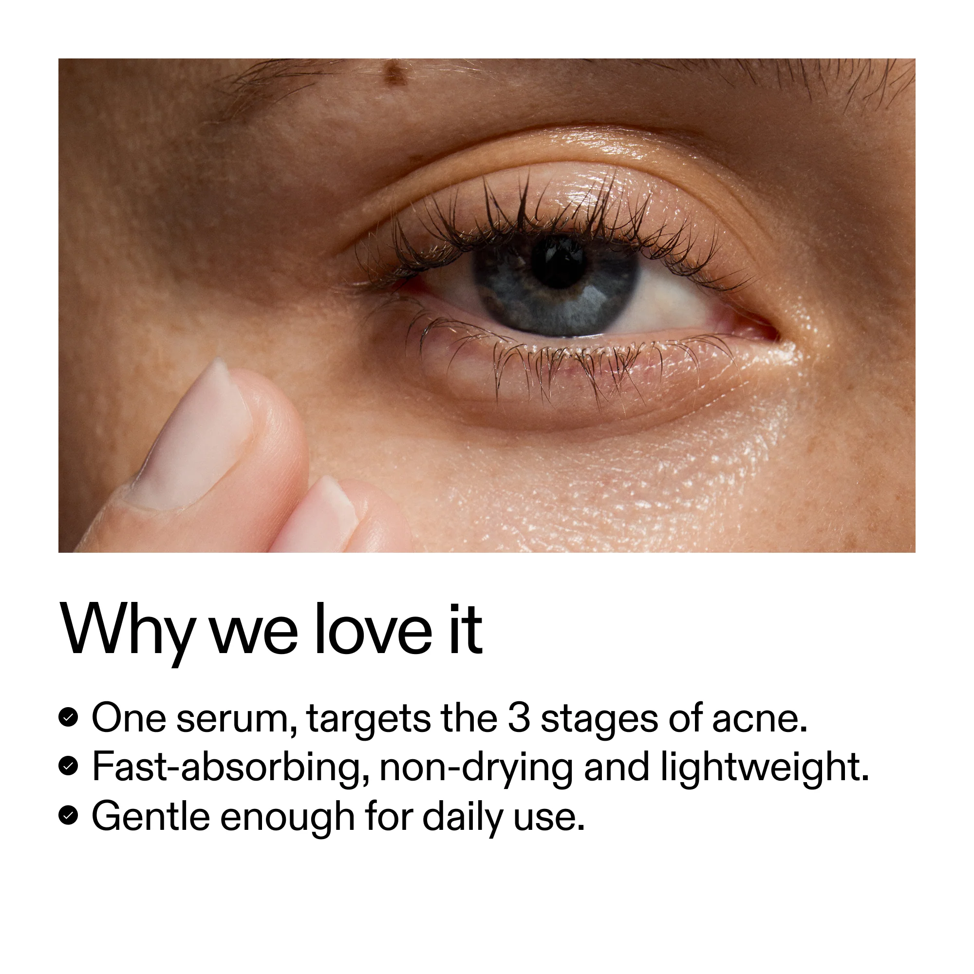 360° Acne Clearing Serum - Image 4