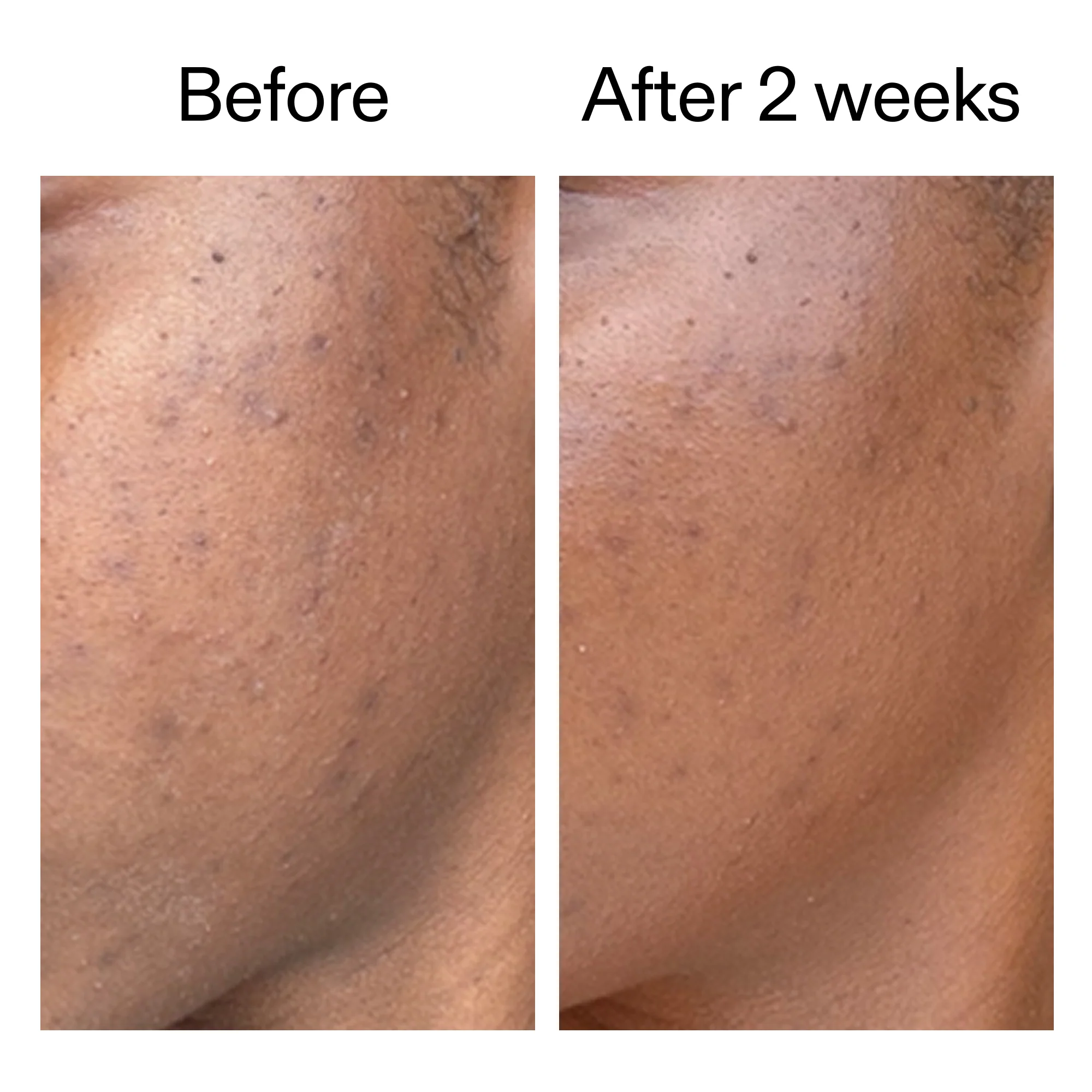 360° Acne Clearing Serum - Image 6