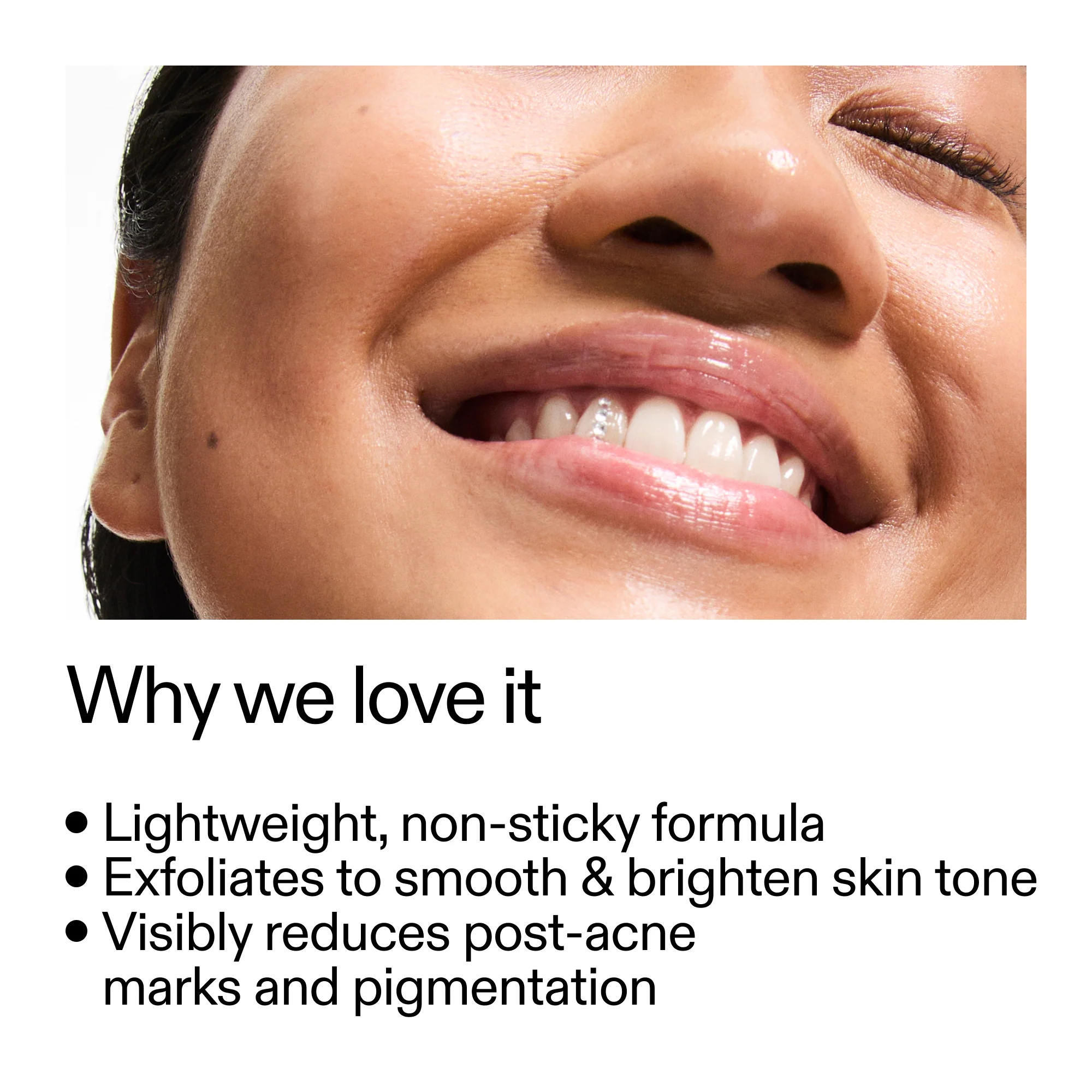 Mandelic Acid Treatment - Image 4