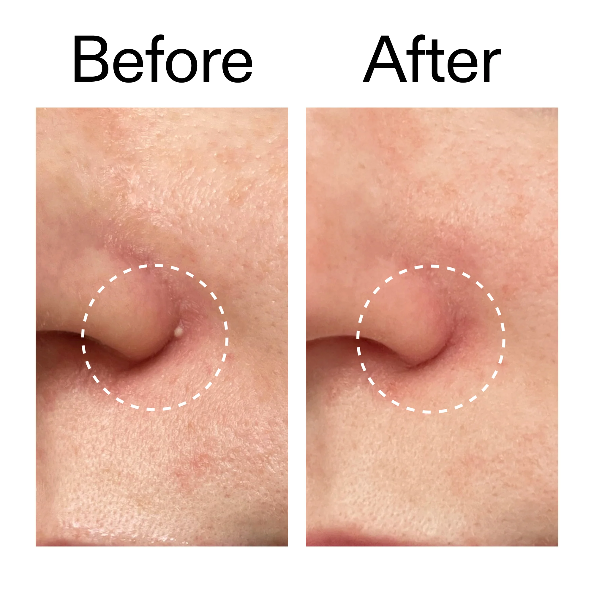 Hydrocolloid Invisible Pimple Patches - Pack of 44 - Image 9